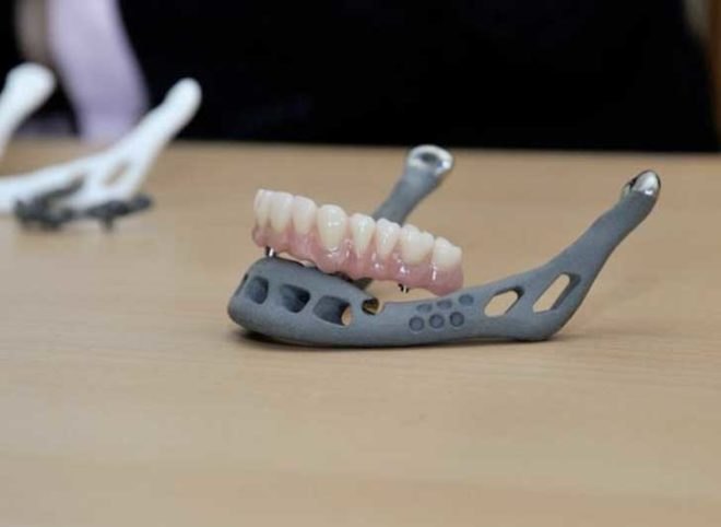 83 year old, titanium jaw, 3d printing, 3d printer, 3d medical printer, medical printing, printing bones, 3d printing bones, 3d printing for medical use, 3d print, jaw replacement, metal jaw replacement, metal jaw