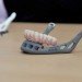 83 year old, titanium jaw, 3d printing, 3d printer, 3d medical printer, medical printing, printing bones, 3d printing bones, 3d printing for medical use, 3d print, jaw replacement, metal jaw replacement, metal jaw