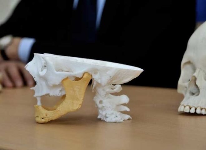 83 year old, titanium jaw, 3d printing, 3d printer, 3d medical printer, medical printing, printing bones, 3d printing bones, 3d printing for medical use, 3d print, jaw replacement, metal jaw replacement, metal jaw