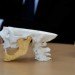 83 year old, titanium jaw, 3d printing, 3d printer, 3d medical printer, medical printing, printing bones, 3d printing bones, 3d printing for medical use, 3d print, jaw replacement, metal jaw replacement, metal jaw