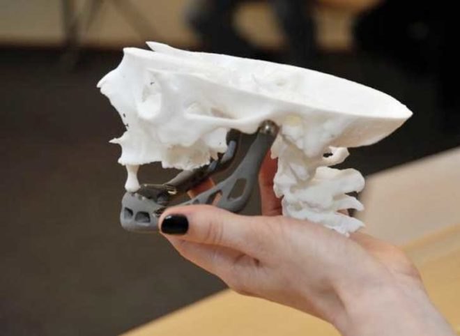 83 year old, titanium jaw, 3d printing, 3d printer, 3d medical printer, medical printing, printing bones, 3d printing bones, 3d printing for medical use, 3d print, jaw replacement, metal jaw replacement, metal jaw