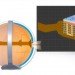 argus ii, electrodes, second sight medical products, bionic eye, retinitis pigmentosa, sight, implant