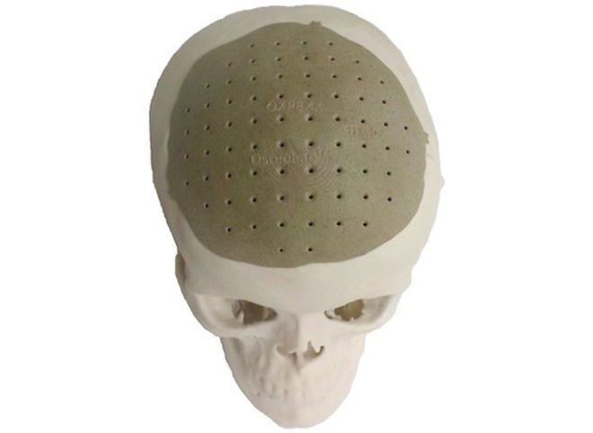 oxford performance materials, prosthetic, skull, 3d printer, technology, additive manufacturing, pekk, replacement