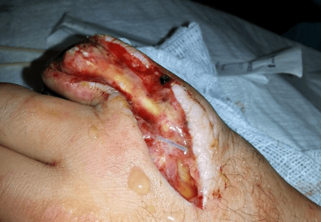University of Oxford, Superglue, Flesh-eating bacteria, Streptococcus pyogenes, necrotizing fasciitis, science, design for health, early cancer detection, chemical bond