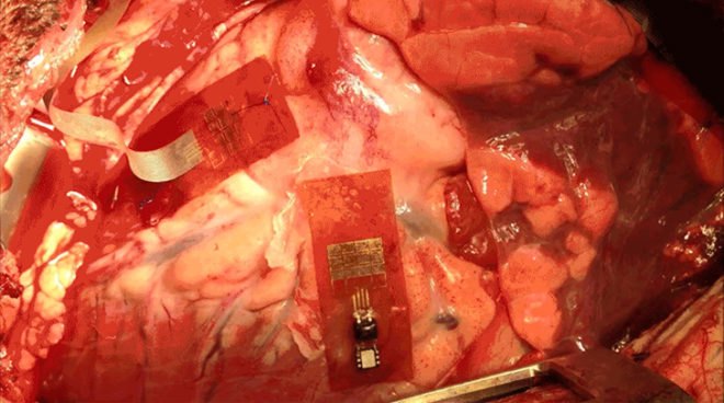 Nanoribbon Heart, Nanoribbon piezoelectric device, piezoelectrics, Tsinghua University in China, Univeristy of Illinois, Implanted Devices, lead zirconate titanate nanoribbons, cyborg heart, implantable devices, medicine, science, future tech, green technology, medical research, implants, implant, heart, lung, diaphragm, medical implants, clinical trials, animal testing, lead