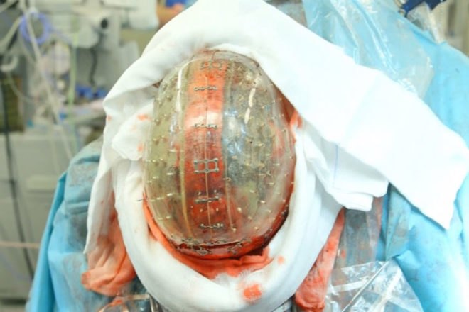 3d printed prosthetics, 3D printed skull, University Medical Centre Utrecht, 3d Printing, 3D printed, plastic, 3D printed skull implant, 3D printed cranium, saving a life, 3D printing in medicine