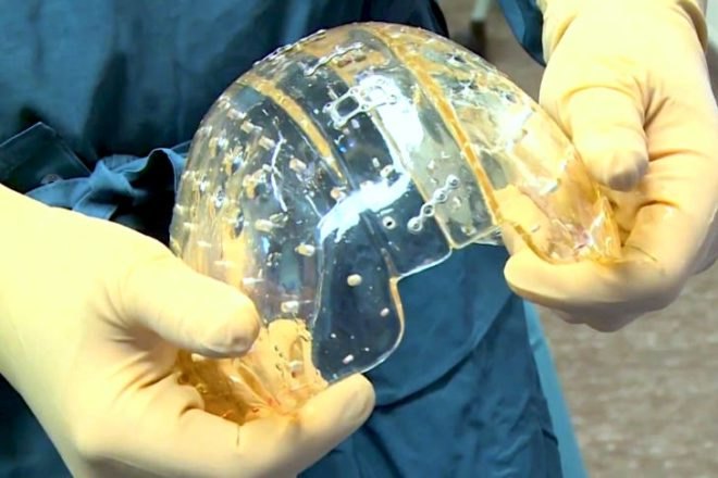 3d printed prosthetics, 3D printed skull, University Medical Centre Utrecht, 3d Printing, 3D printed, plastic, 3D printed skull implant, 3D printed cranium, saving a life, 3D printing in medicine
