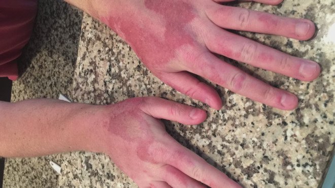 florida man, lime disease, margarita dermatitis, second degree burns from lime juice, citric acid and sun, citric acid sun exposure, health