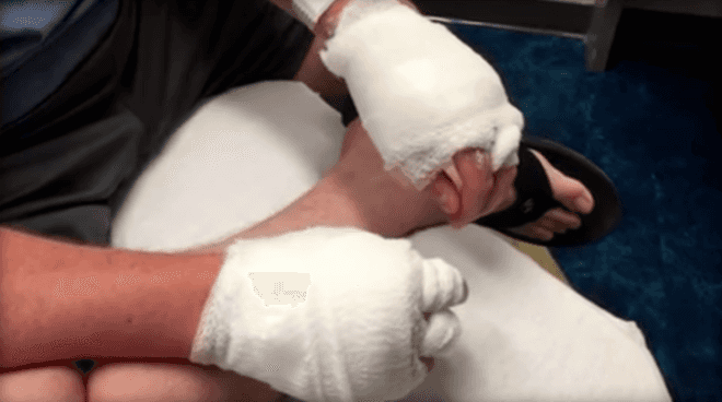 florida man, lime disease, margarita dermatitis, second degree burns from lime juice, citric acid and sun, citric acid sun exposure, health