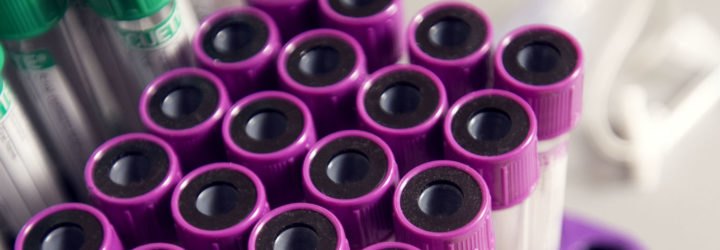 HIV, HIV AIDS, AIDS, HIV virus, virus, immune system, blood, lab, lab tests, lab testing, HIV cure