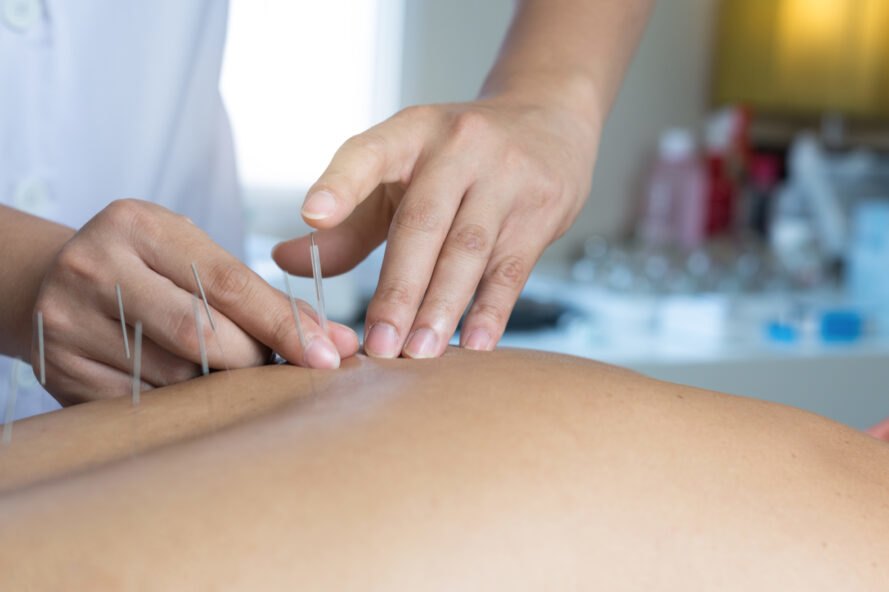 acupuncture
